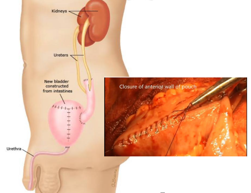 Bladder Cancer Treatment in Meerut