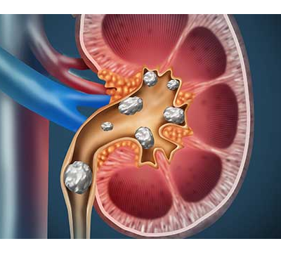 Kidney Stone Doctor in Meerut