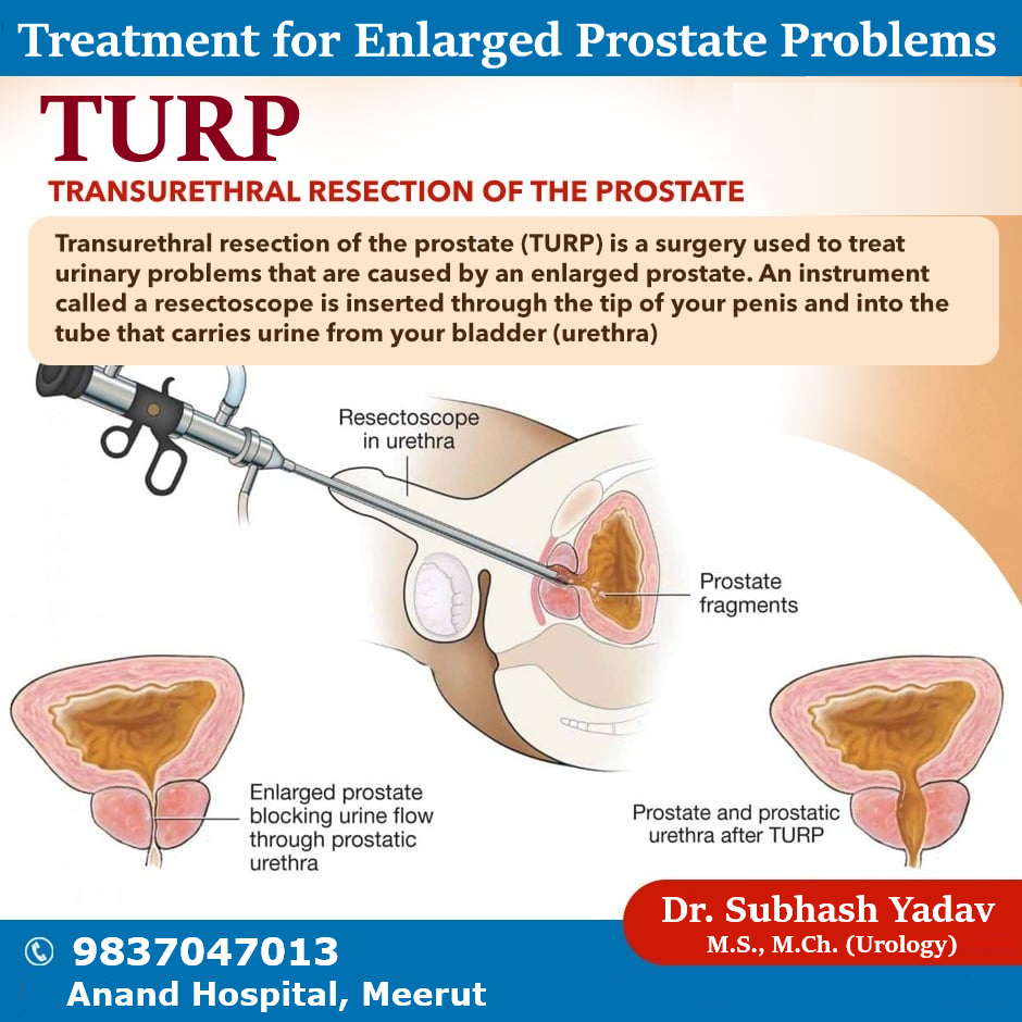 Turp in Meerut